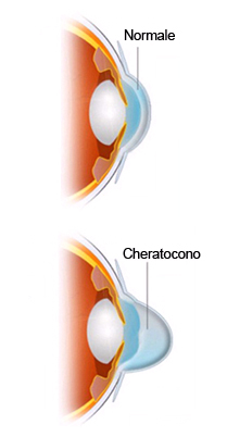 Cheratocono
